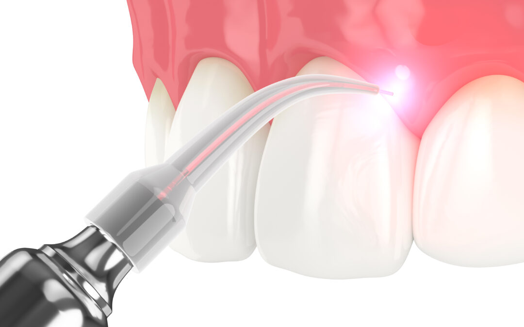 Laser Dentistry: A Cutting-Edge Solution for Dental Care