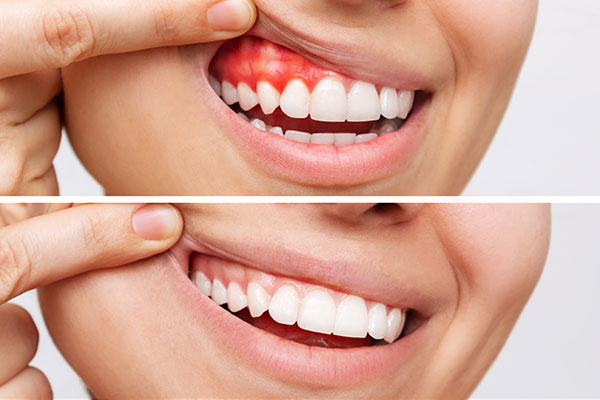 Why You Shouldn’t Ignore Bleeding Gums